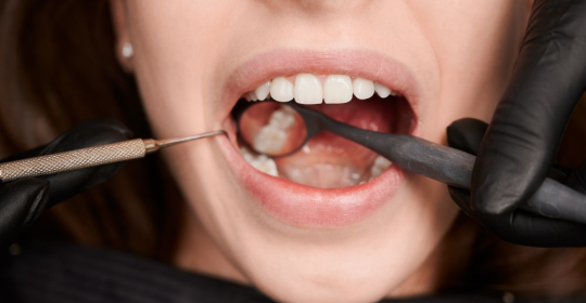 Why You Keep Getting Cavities (Even With Good Habits)